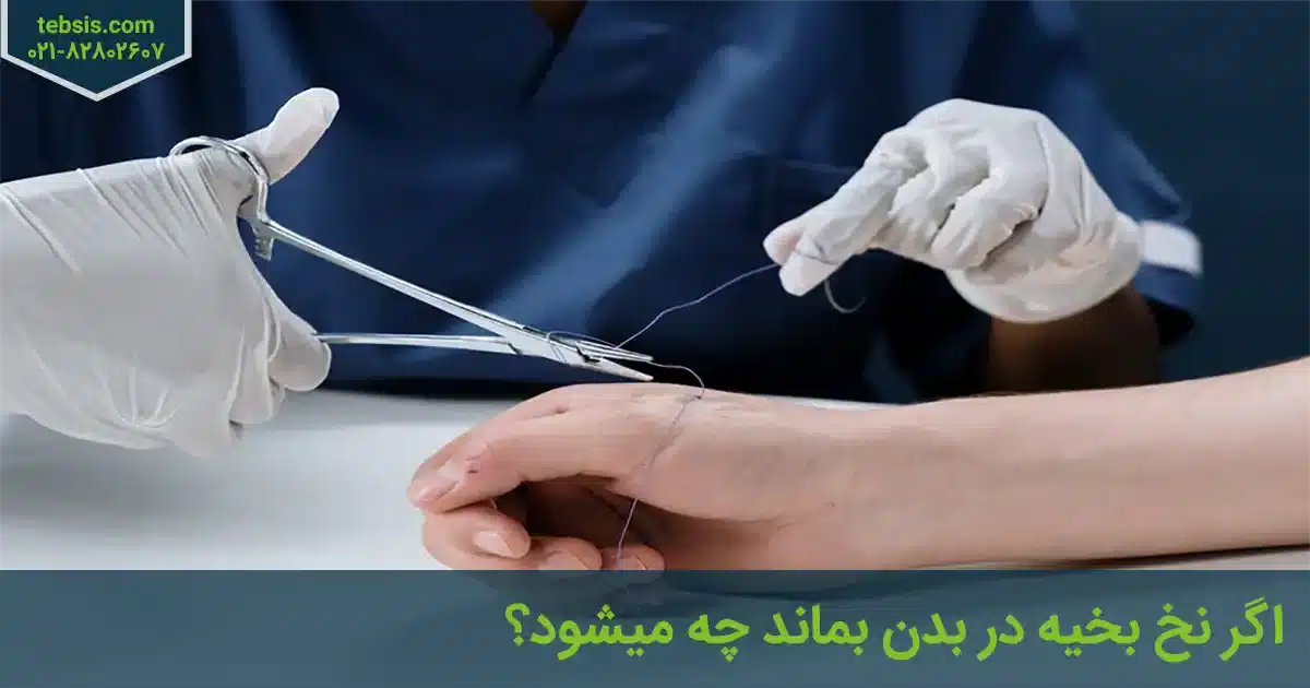 ماندن نخ بخیه در بدن