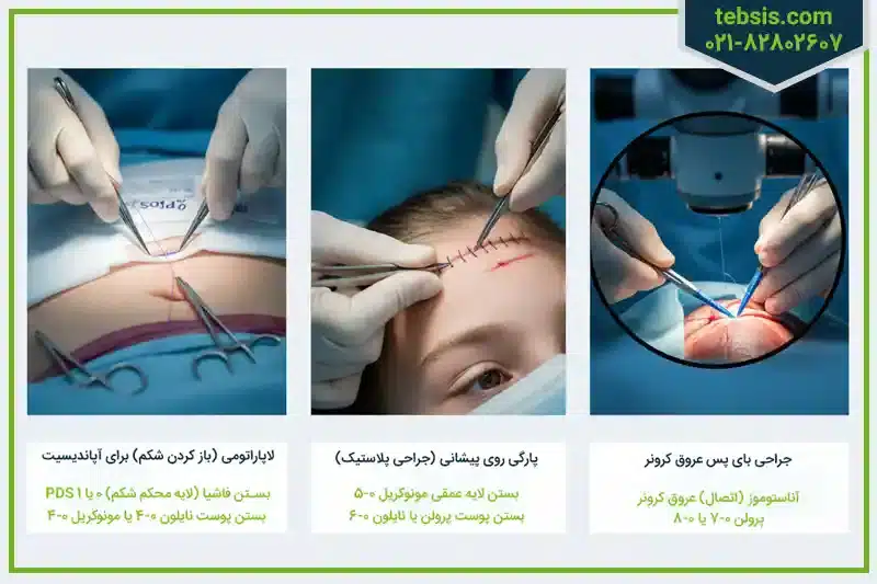 سایز نخ بخیه در عمل جراحی